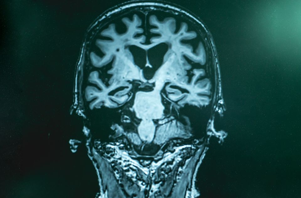 Macroscopic manifestation on a brain scan